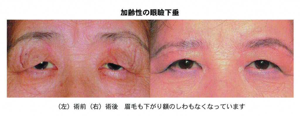 加齢性の眼瞼下垂